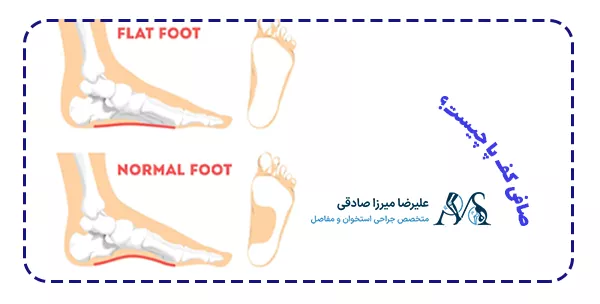 صافی کف پا چیست؟