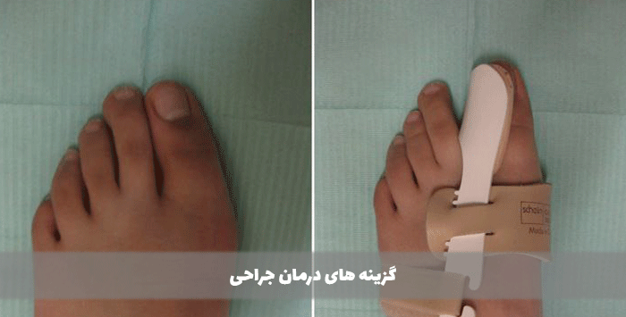 گزینه های درمان جراحی
