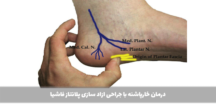 ازاد سازی پلانتاز فاشیا