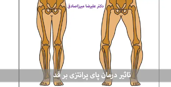 تاثیر درمان پای پرانتزی بر قد