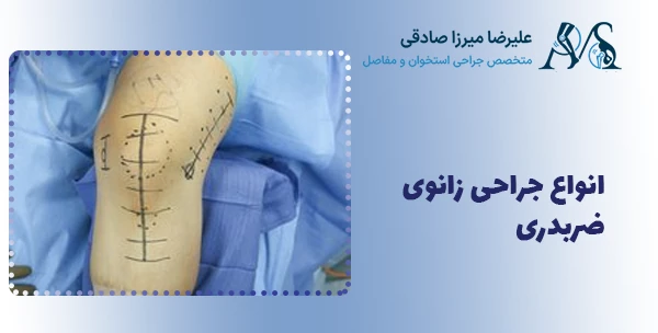انواع جراحی زانوی ضربدری