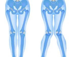 جراحی پای ضربدری