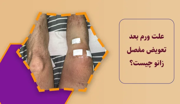 علت ورم بعد تعویض مفصل زانو چیست؟