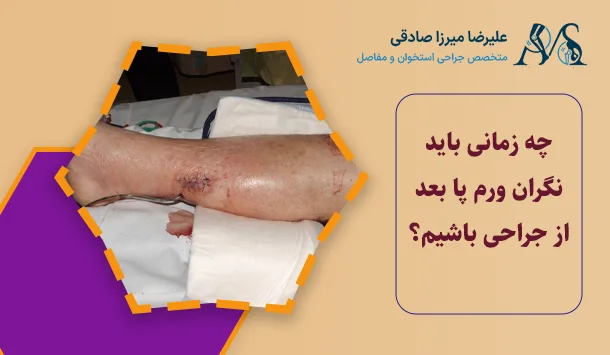 چه زمانی باید نگران ورم پا بعد از جراحی باشیم؟