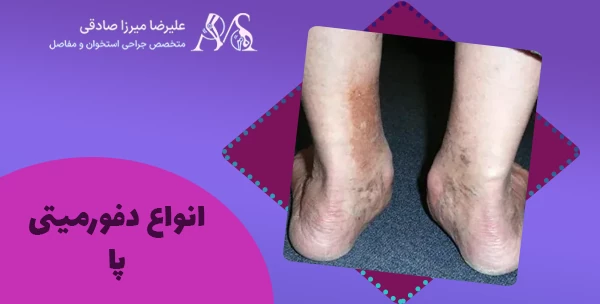 انواع دفورمیتی پا