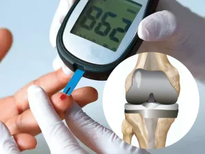تعویض مفصل زانو در افراد دیابتی