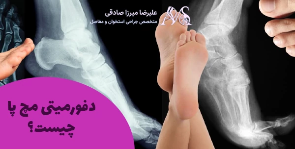 دفورمیتی پا چیست؟