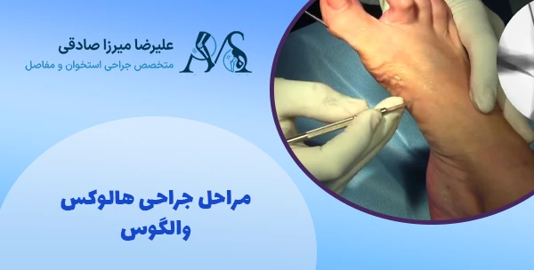 مراحل جراحی هالوکس والگوس
