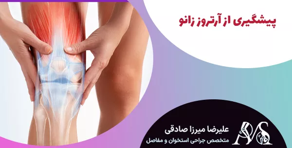 پیشگیری از آرتروز زانو 