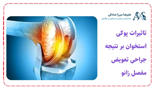 تاثیرات پوکی استخوان بر نتیجه جراحی تعویض مفصل زانو
