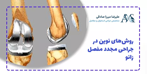 روش‌های نوین در جراحی مجدد مفصل زانو