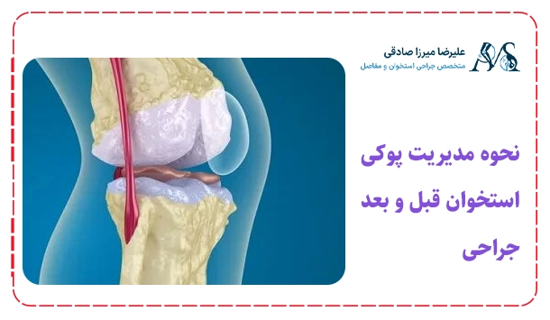 نحوه مدیریت پوکی استخوان قبل و بعد جراحی
