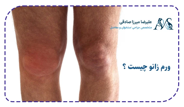 ورم زانو چیست ؟