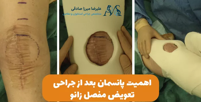اهمیت پانسمان بعد از جراحی تعویض مفصل زانو