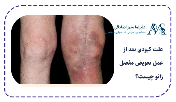 علت کبودی بعد از عمل تعویض مفصل زانو چیست؟