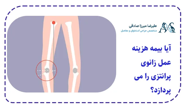 آیا بیمه هزینه عمل زانوی پرانتزی را می پردازد؟
