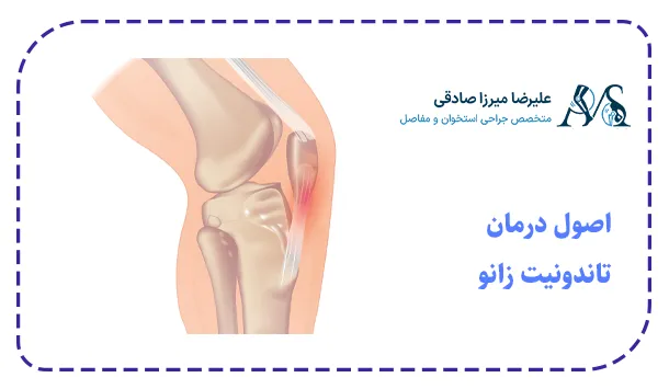 اصول درمان تاندونیت زانو