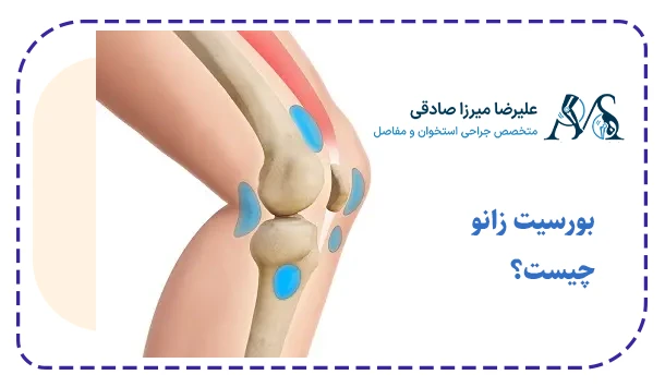 بورسیت زانو چیست؟