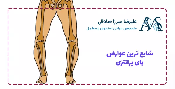 شایع ترین عوارض پای پرانتزی