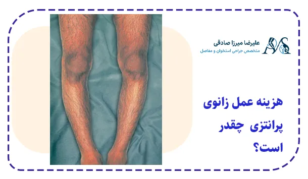 هزینه عمل زانوی پرانتزی  چقدر است؟