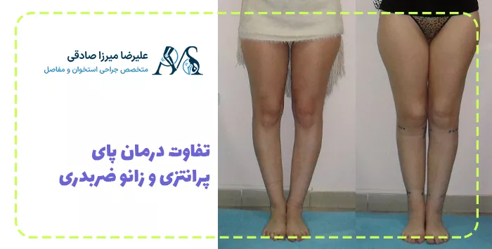 تفاوت درمان پای پرانتزی و زانو ضربدری