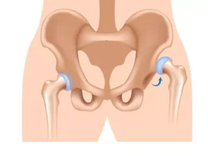 دررفتگی مفصل لگن