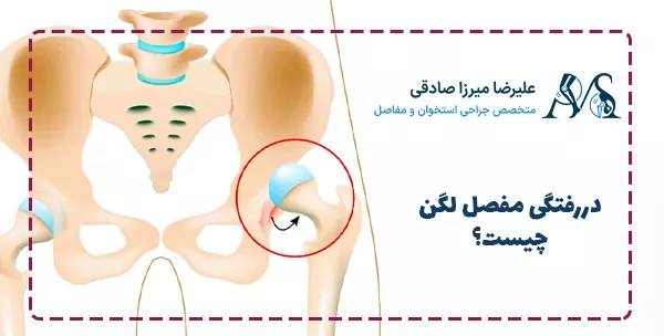دررفتگی مفصل لگن چیست؟