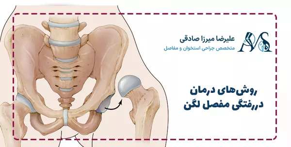 روش‌های درمان دررفتگی مفصل لگن