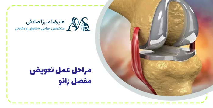 مراحل عمل تعویض مفصل زانو 
