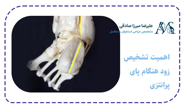 اهمیت تشخیص زود هنگام پای پرانتزی