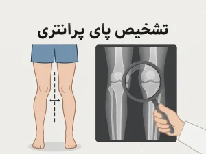 تشخیص پای پرانتزی