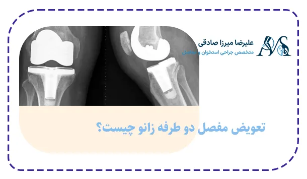 تعویض مفصل دو طرفه زانو چیست؟