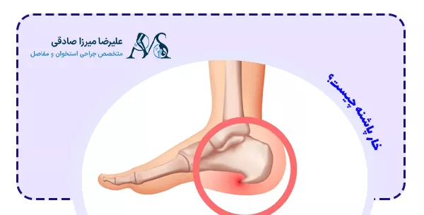 خار پاشنه چیست؟