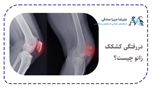 دررفتگی کشکک زانو چیست؟