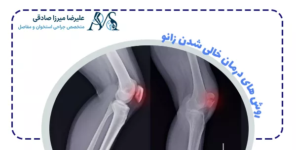روش های درمان خالی شدن زانو
