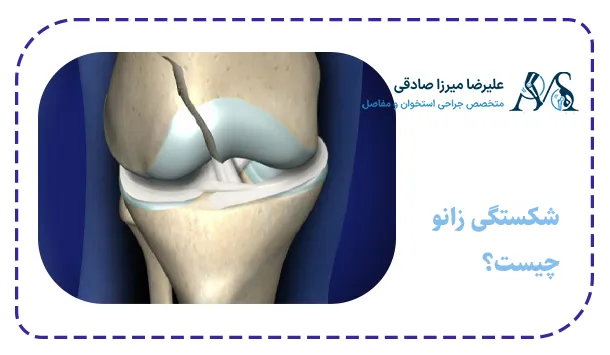 شکستگی زانو چیست؟