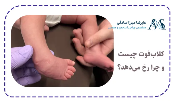 کلاب‌فوت چیست و چرا رخ می‌دهد؟