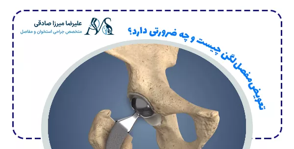 تعویض‌مفصل‌لگن چیست و چه ضرورتی دارد؟