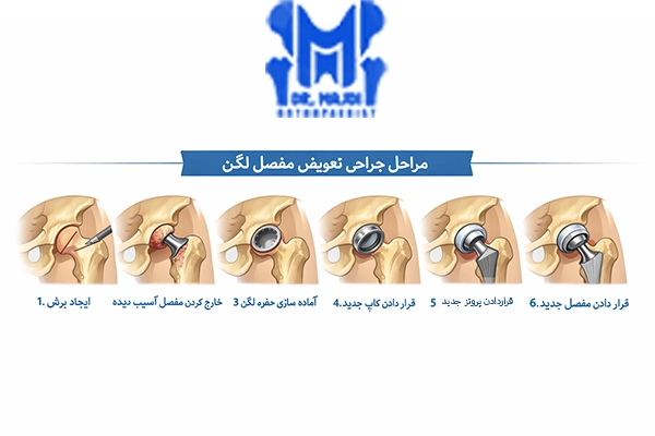 مراحل تعویض مفصل لگن