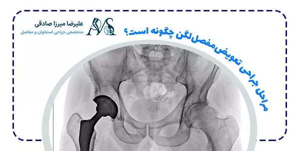 مراحل جراحی تعویض‌مفصل‌لگن چگونه است؟