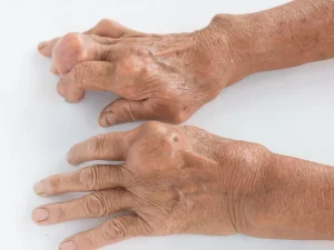 نقرس