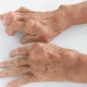 نقرس