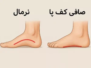 جراحی صافی کف پا