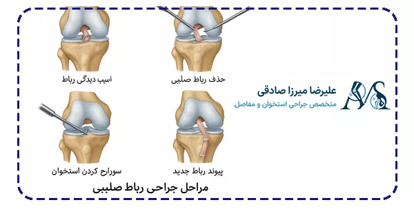 جراحی پارگی رباط صلیبی چگونه انجام می‌شود؟