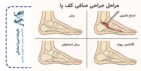 روش‌های عمل صافی کف پا