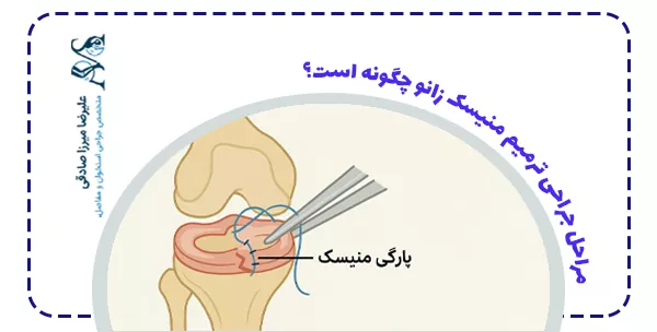 مراحل جراحی ترمیم منیسک زانو چگونه است؟