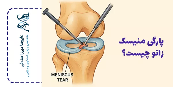 پارگی منیسک زانو چیست؟