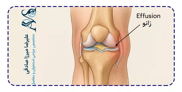 افیوژن زانو دقیقا چیست؟