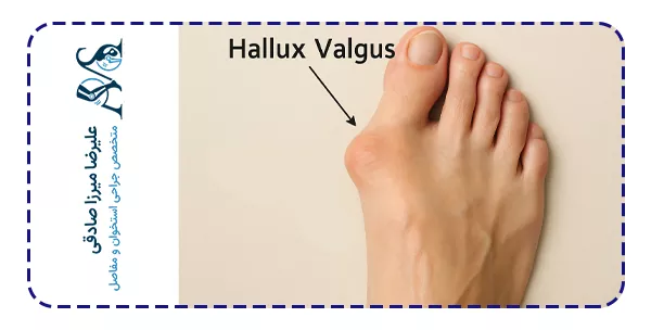 هالوکس والگوس یا انحراف شست پا چیست؟