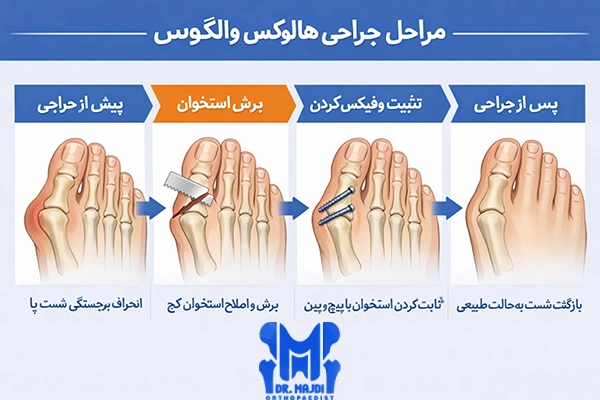 مراحل جراحی هالوکس والگوس